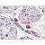 Immunohistochemistry: SM2251PS/PT FCER1A antibody staining of Formalin-Fixed, Paraffin-Embedded Human Mast Cells at 10 µg/ml followed by biotinylated anti-mouse IgG secondary antibody, alkaline phosphatase-streptavidin and chromogen.