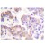 Immunohistochemistry Analysis: AP20205PU-N APC1 antibody staining of Paraffin-Embedded Human breast carcinoma tissue.