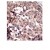 Formalin-fixed and paraffin-embedded human cancer tissue reacted with the primary antibody, which was peroxidase-conjugated to the secondary antibody, followed by AEC staining. This data demonstrates the use of this antibody for immunohistochemistry. Clinical relevance has not been evaluated.