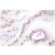 Immunohistochemistry analysis of THRB / ERBA2 Antibody (Cat.-No.: AP06354PU-N) in paraffin-embedded human lung carcinoma tissue.