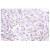 Immunohistochemistry (IHC) analyzes of Histone H2A antibody (Cat.-No.: AP06486PU-N) in paraffin-embedded Human breast carcinoma tissue.