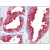 AM20526PU-N ACPP antibody staining Formalin-Fixed, Paraffin-Embedded Human Prostate  at 5 µg/ml followed by biotinylated anti-Mouse IgG secondary antibody, alkaline phosphatase-streptavidin and chromogen.