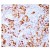 Immunohistochemical analysis of Paraffin Embeedded Mammary cancer sections using FGF2 antibody. 
Staining FGF2 in Cytoplasm.
DAB chromogenic reaction.