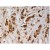Immunohistochemistry staining of AGR3 with Mouse monoclonal AGR3.1 in Paraffin-Embedded Sections of breast carcinoma.