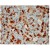 Formalin-Fixed, Paraffin-Embedded Human Hodgkin’s lymphoma stained with Fascin antibody Cat.-No. AM10085SU-N using peroxidase conjugate and DAB chromogen. Note the cytoplasmic staining of Hodgkin's cells.