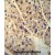ABCD1 antibody (Center) (Cat. #AP50017PU-N) immunohistochemistry analysis in formalin fixed and paraffin embedded human hepatocarcinoma followed by peroxidase conjugation of the secondary antibody and DAB staining. This data demonstrates the use of the ABCD1 antibody (Center) for immunohistochemistry. Clinical relevance has not been evaluated.