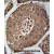 ACN9 Antibody (N-term) (Cat. #AP50048PU-N) immunohistochemistry analysis in formalin fixed and paraffin embedded human hepatocarcinoma followed by peroxidase conjugation of the secondary antibody and DAB staining. This data demonstrates the use of the ACN9 Antibody (N-term) for immunohistochemistry. Clinical relevance has not been evaluated.