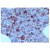 Formalin-Fixed, Paraffin-Embedded Human bone marrow with hairy cell leukemia stained with TRAcP antibody Cat.-No. AM10145SU-N using peroxidase conjugate and DAB chromogen. Note the cytoplasmic staining of leukemia cells.