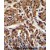 AKT1 Antibody (C-term T450) (Cat. #AP50137PU-N)immunohistochemistry analysis in formalin fixed and paraffin embedded human breast carcinoma followed by peroxidase conjugation of the secondary antibody and DAB staining.This data demonstrates the use of AKT1 Antibody (C-term T450) for immunohistochemistry. Clinical relevance has not been evaluated.