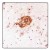 Beta-Amyloid-positive “neuritic plaque” in cerebral cortex as seen in a post-mortum specimen taken from an Alzheimer's disease patient. Picture courtesy of Dr. Randy Woltjer, Oregon Health & Sciences University.