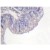 Immunohistochemistry (IHC) analyzes of PLCG1 antibody (Cat.-No AP06287PU-N) in paraffin-embedded human breast carcinoma tissue.