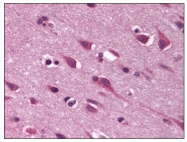 gastric cancer introduction