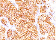 AM32835PU-S - Renal Cell Carcinoma