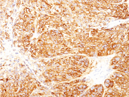 AM50295PU-S - Melanoma Marker (MART-1 + gp100)
